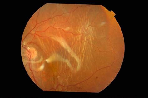 Retinal Folds Following Retinal Reattachment Surgery Retina Image Bank