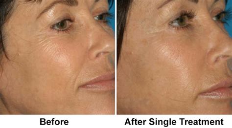 I'm convinced that they're going to make it worse. Microneedling - Paramus, NJ | Create New Collagen