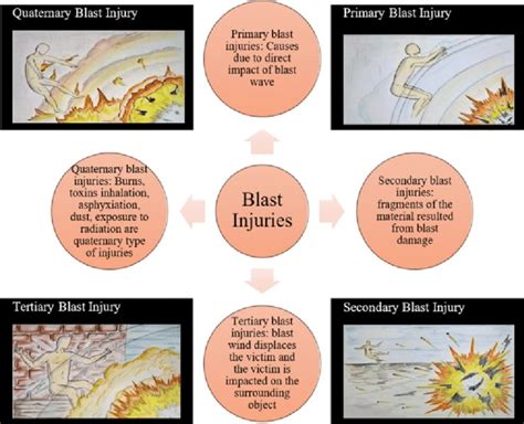 1 Types Of Blast Injuries Reproduced From 21 Download Scientific