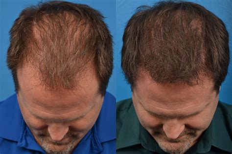 Hair Restoration 2023 What Can We Expect To See ~ All About Best Hair Restoration