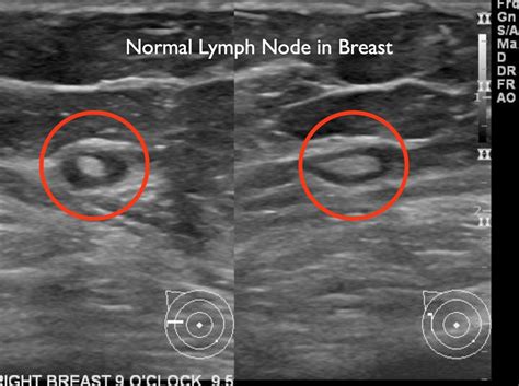 Does Bladder Cancer Show On Ultrasound Updated