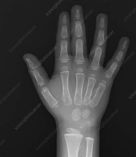 Normal Hand Of Child X Ray Stock Image C0393335