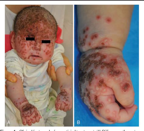 The infection lies in a cluster of nerve cells near the ear called the trigeminal ganglion. Oral treatment with valacyclovir for HSV-2-associated eczema herpeticum in a 9-month-old infant ...