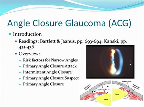Ppt Diagnosis And Management Of Angle Closure Glaucoma Powerpoint