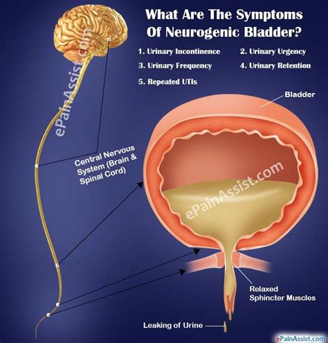 What Are The Symptoms Of Neurogenic Bladder Bladder Incontinence Overactive Bladder Remedies