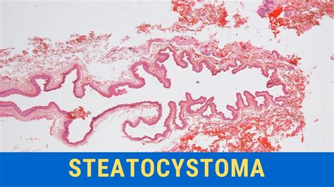 Steatocystoma Pathology Mini Tutorial Youtube