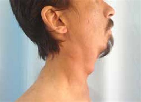 Lateral View Of The Neck Swelling Investigations Showed Elevated