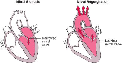 Heart Valve Disorders Flashcards Quizlet