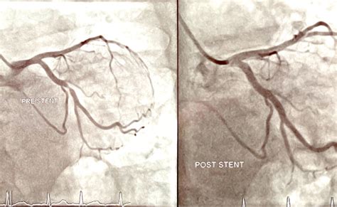Coronary Angiography Stents And Angioplasty Nsw Cardiology