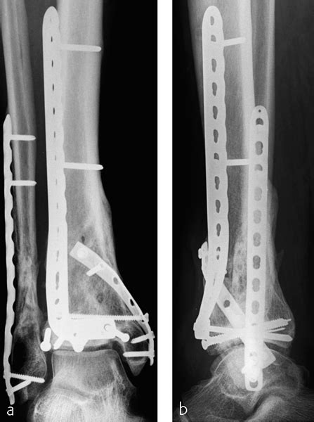Tibia And Fibula Distal Intraarticular Complex Fracture Of The Distal