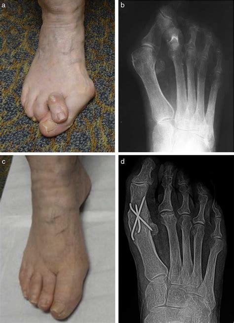 Use Of 1st Metatarsophalangeal Joint Fusion For Repair Of Geriatric