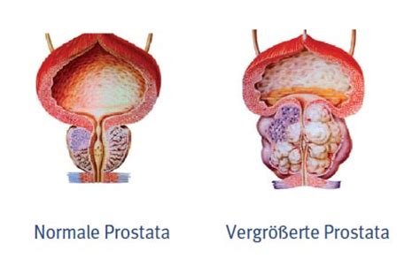 Zudem unterstützt sie den verschluss der harnblase und wandelt das männliche geschlechtshormon testosteron in seine biologisch aktivste form um. Enfermería Urológica