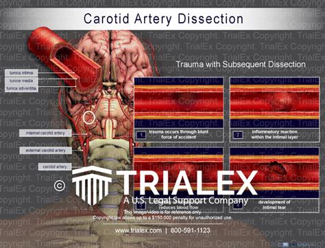 Carotid Artery Dissection Trialexhibits Inc