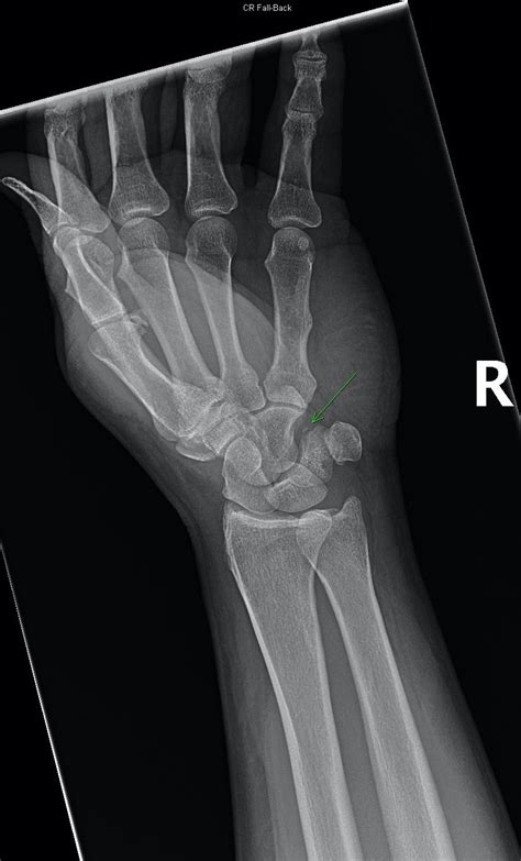 Dislocated Wrist X Ray