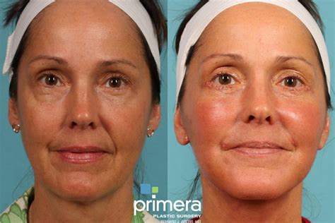 Mini Facelift Before And After Pictures Case 195 Orlando Florida