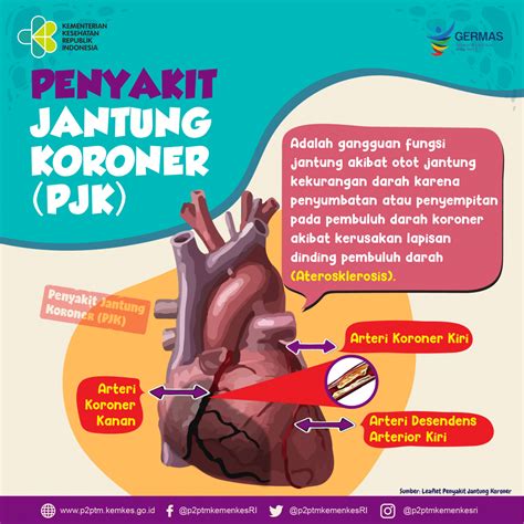 Chikugunya adalah penyakit yang ditandai dengan gejala demam, nyeri pada sendi, ruam pada kulit, dan tubuh lunglai dan lemas tidak seperti biasanya. Apa Definisi Penyakit Jantung Koroner (PJK)? - Direktorat ...