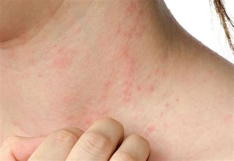Todo Lo Que Debes Saber Sobre La Dermatitis At Pica