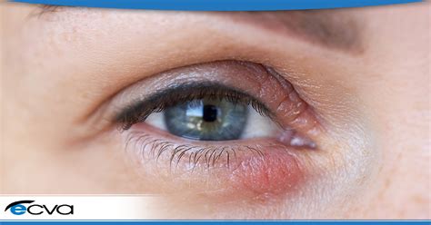 What Is Eyelid Dermatitis