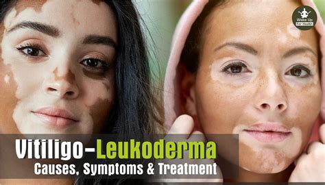 Leukoderma Vitiligo Causes Best Treatment Diet And Home Remedies By