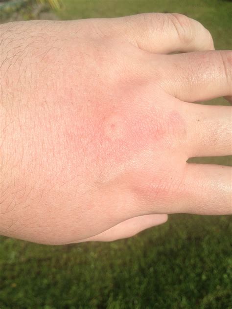 Todays Lesson What Not To Do And What A Normal Bee Sting Reaction Looks