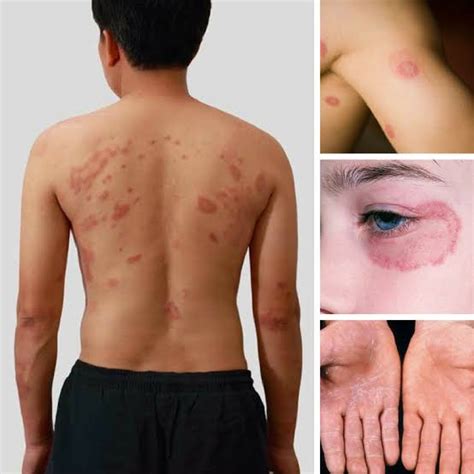 9 Really Useful Home Remedies For Fungal Infection On Body 99 Health