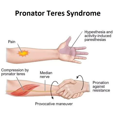Pronator Teres Syndrome Pts Cause Symptoms Treatment Mobile