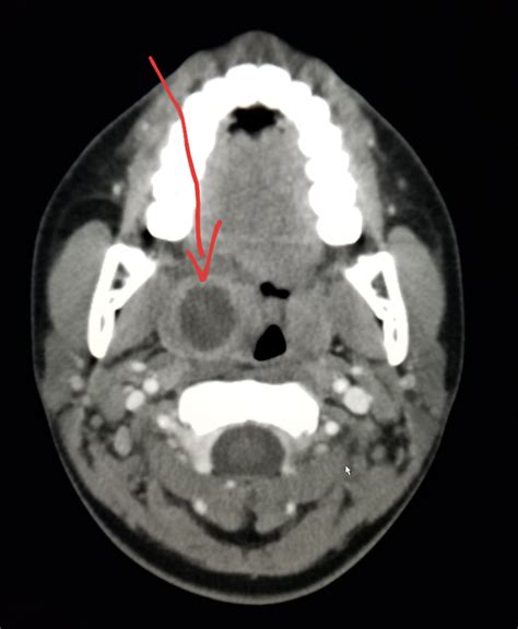 Neck Ct Tonsillitis With An Abscess In Patient With Sore Throat And