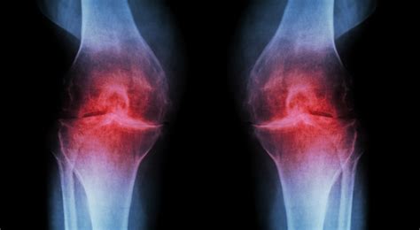 Find Out Whats Causing Your Chronic Knee Pain Arkansas Surgical Hospital