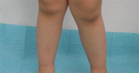 Knock Knees In Children Are Usually Not Treated If The Problem Is