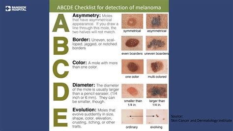 Skin Cancer The Abcde Checklist That Can Help You Look For Signs Of