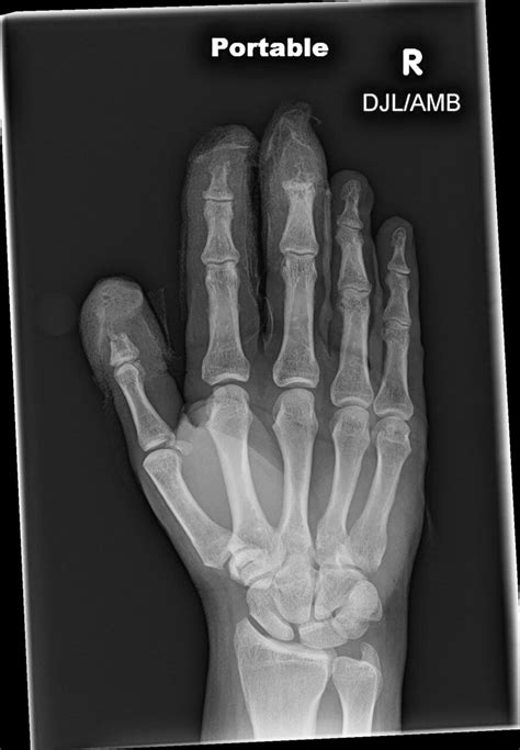 Orthodx Fingertip Amputations Clinical Advisor