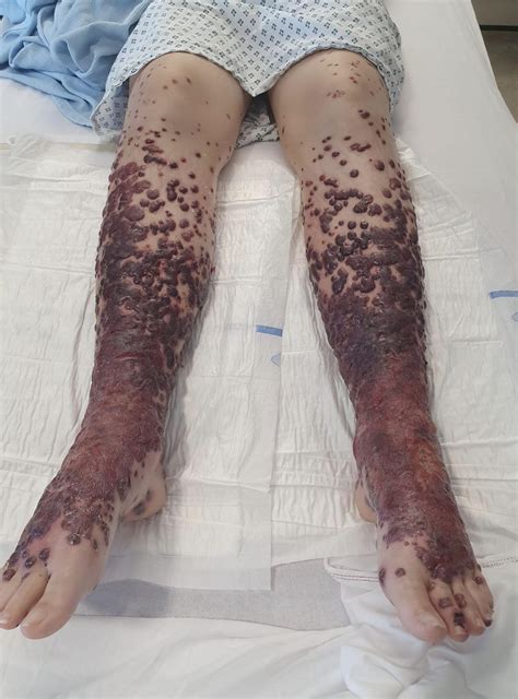 The astrazeneca covid vaccine has not been approved in the united states yet, but the news is encouraging. Woman's legs after getting AstraZeneca vaccine - Conspiracies - Conspiracy Theories & Facts