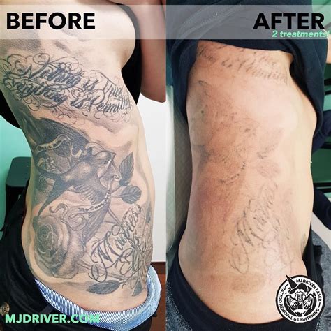 This method is efficient for natural tattoo removal, and gets rid of the tattoo's attached skin cells with use of the sand grit. Laser tattoo removal at WA Ink by @mjdriverlasertattooremoval and @swlaser_tattooremoval 2 ...