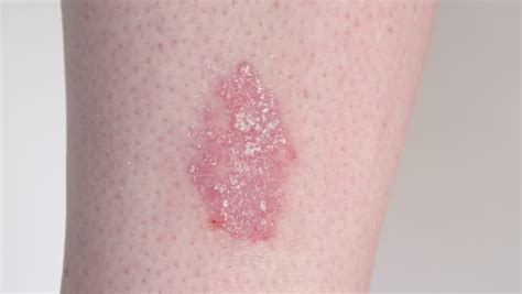 Dry Patches On Skin Atopic Dermatitis Symptoms