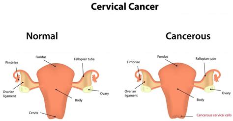 What Is Cervical Cancer Stage 3 With Pictures