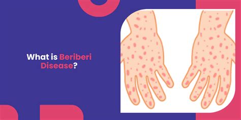 What Is Beriberi Disease Beriberi Symptoms Causes And Treatment
