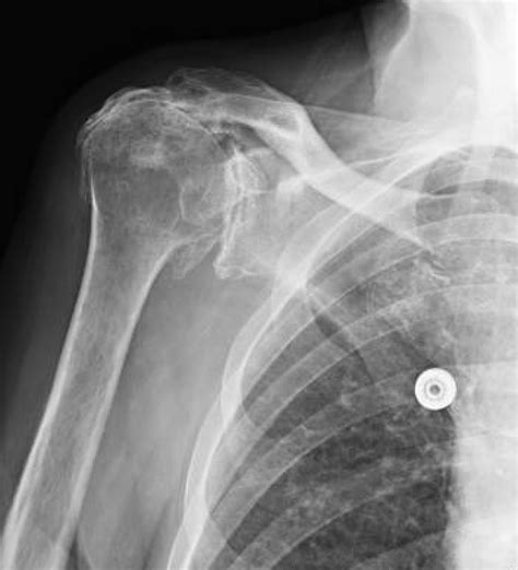 Shoulder And Elbow Surgery Dislocation Of Reverse Shoulder Replacement