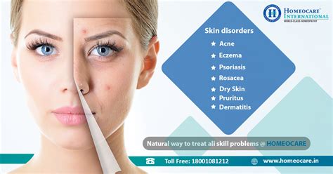 One Solution For All Skin Diseases Homeocare International