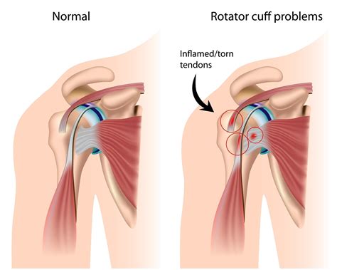 For secondary impingement, surgery can have good to excellent results depending on the direction of shoulder looseness. Shoulder Impingement Syndrome - BodyChek