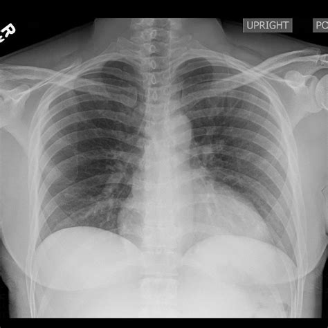 Normal Chest X Ray Male