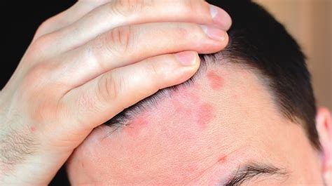 Eczema Hairline