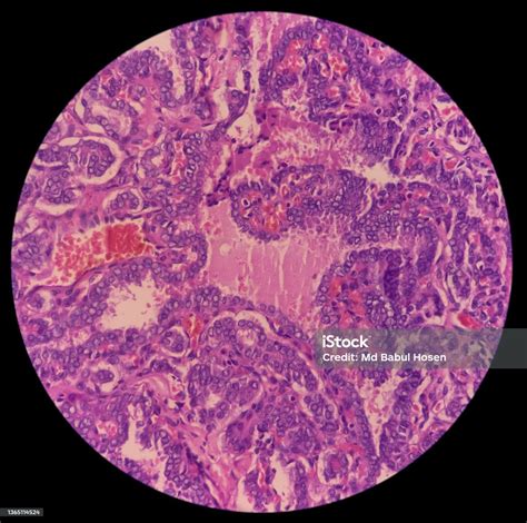Cervical Lymph Node Cancer Microscopic Image Of Metastatic Papillary