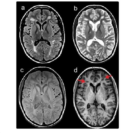 Mri Of Ms Lesions Images