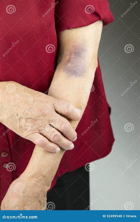 Large Bruise On Human Arm Stock Photo Image Of Hurt 52499548