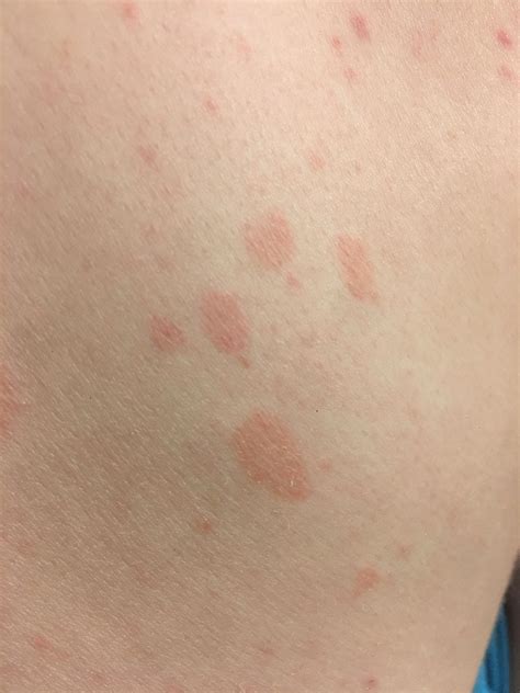 Red Patches Developing For About A Year Dermatologist Wasnt Very Sure