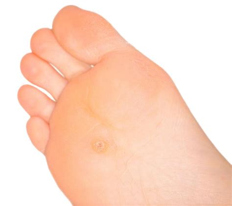 How Can I Get Rid Of Calluses On My Feet With Pictures