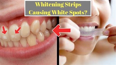 How To Remove Brutal White Spots On Teeth From Whitening Strips
