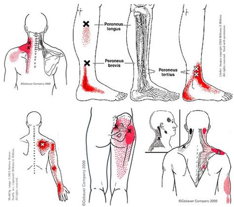 Pain that feels hot, tingling, or electric is more likely caused by an irritated nerve root, not a pulled muscle. Triggerpoint therapie - RG Therapie