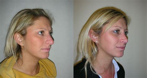 Rhinoplasty Nose Job Surgery In Manchester And London Waseem Saeed