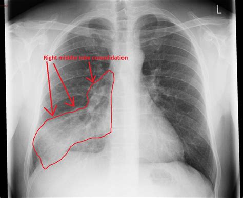Diagnosing Pneumonia On Chest X Ray Medical Exam Prep Hot Sex Picture